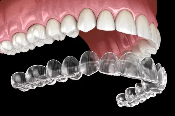 Invisible Aligners